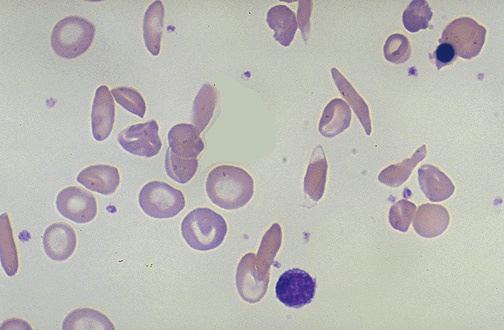 aminosav Glu helyett Val. Hemolitikus anaemiák corpusculáris formák Sarló sejtes anaemia A desoxi-hbs, oldékonysága csökken, a vénás keringésben a HbS egy része kristályokat képez.