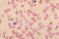 Hemolitikus anaemiák corpusculáris formák Sarló sejtes anaemia kéz és láb szindróma A gyakori kis