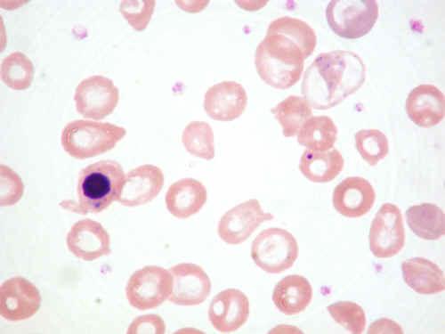 Hemolitikus anaemiák corpusculáris formák Thalassaemia: Csökkent α vagy β lánc szintézis miatt kialakuló