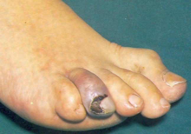 Essentialis (primer) thrombocytaemia Tünetek/klinikai jellemzők: Gyengeség Vérzés!! - általában enyhe > orr, GI Trombosis!!, ujjelhalások!