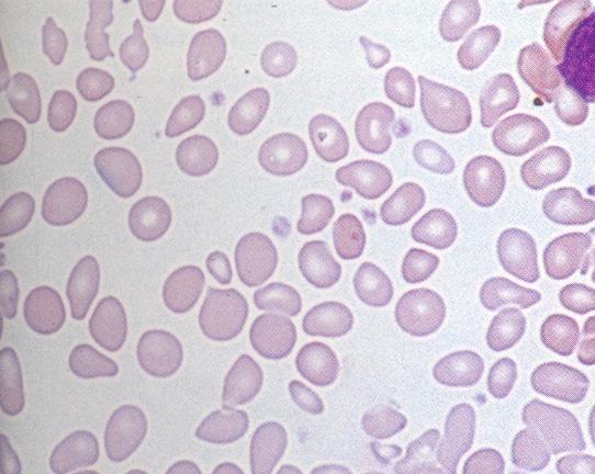 Myelofibrosis Chronikus myeloid leukaemia (CML) Első leírás a betegségről: Wirchow Ph kromoszóma felfedezés: 1960