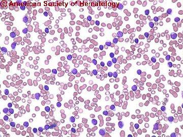 infiltrációjával és kifejezett perifériás lymphocytosissal jellemzett
