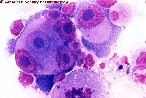 WHO klasszifikáció (1997) Nodularis lymphocyta predominancia (NLPHL)