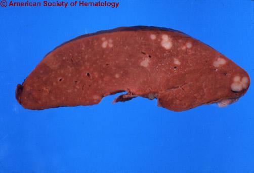 2: sok S-R sejt) NS Lymphocyta gazdag klasszikus Hodgkin kór LRCHD Mixed