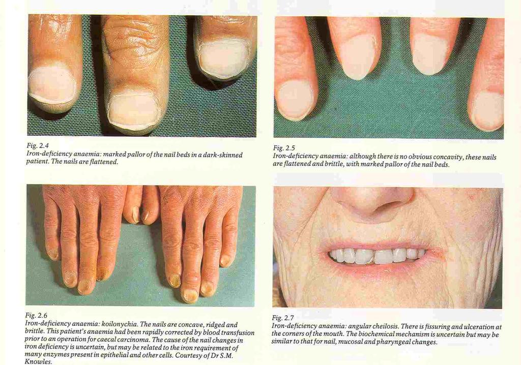 A Fe-hiány egyéb következményei Stomatitis angularis, fájdalmatlan glossitis, lapos, esetleg konkáv körmök, hajhullás, száraz bőr,