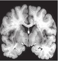 neurológiai, neuropszchiológiai vizsgálat EEG képalkotók o funkcionális: PET, SPECT o