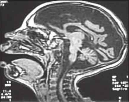 28 Idejében kiderül Az idegrendszer fejlődési folyamata/ fejlődési rendellenességek Velőcsőzáródási zavarok/dysraphismusok Spina bifida occulta,meningocele, Myelomengingocele, Rejtett dysraphiák,