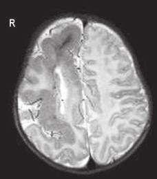 Többszörös fejlődési rendellenesség 3. Neurológia: Hypotonia Jellegzetes külső jegyek West syndroma 1.