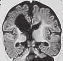 Koraszülöttek Éretlen központi idegrendszer sérülékenysége Hipoxiás-ischemiás encephalopathia Periventricularis leucomalatia/porencephalias cysta Cerebral paresis Perinatalis sérülések II.
