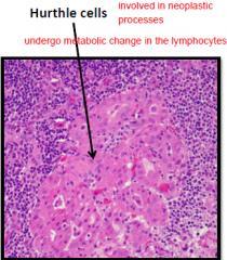 Oncocytaer jellegű sejtek Hürthle-sejtek (mitochondriumok megemelkedett száma) Előrehaladott állapotban az interstitium