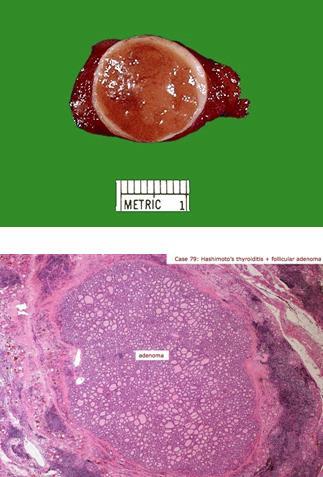 Daganatok Follicularis neoplasiák Legygakrabban benignus: follicularis adenoma Szoliter, jól körülhatárolt, tokkal bíró lézió Mérete, színe (szürkésfehér, vörösesbarna), megjelenése (bevérzések,