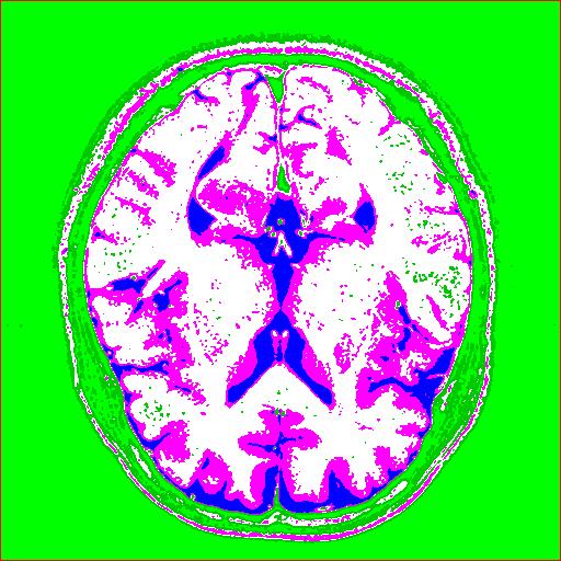 ALKALMAZÁS 97 6.4. ábra. Eredeti T2 súlyozású MRI agyfelvétel (a) C szimuláció (b) VHDL szimuláció (c) Különbségi kép 6.5. ábra. A Kohonen hálózattal osztályozott kép A különbségi kép a 6.5(c).