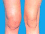 Spondyloarthritis: a