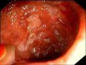kísérő betegségek infekció* psoriasis Crohn betegség *a