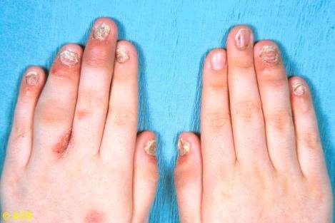 DIP arthritis (5-20%) a DIP arthritis gyakran