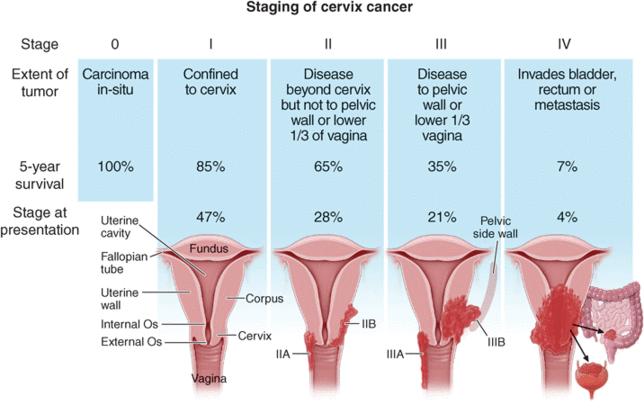 4. ábra: A cervix daganat FIGO szerinti stádiumbeosztása (60) A prekancerózus állapotok leírására az 1950-es évektől használt Papanicolau beosztást az utóbbi évtizedekben felváltotta a napjainkban