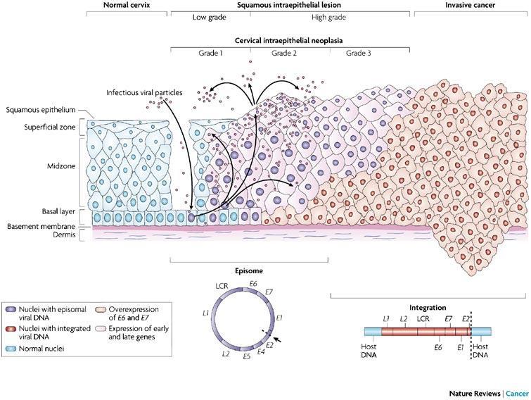 7. ábra: A HPV által mediált cervicalis malignus transzformáció lépései, jellegzetes hámelváltozások feltüntetése mellett (157) 3.d. Cervix dysplasia és daganat: prevenció jelene és jövője Elhelyezkedése miatt a méhnyak jól vizsgálható szerv.