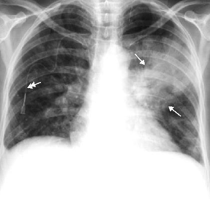 beszűrődéses foltárnyék): bronchopneumoniák, abscessusok,