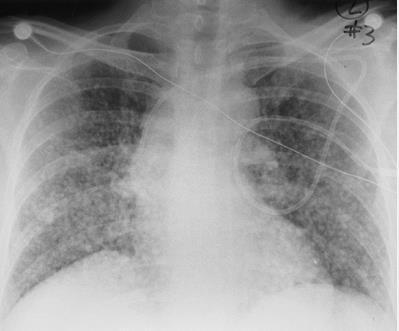 Metastasisok Hematogén terjedés: a. pulmonalison vagy a. bronchialison át Lymphatikus terjedés: emlő, bronchuscc.