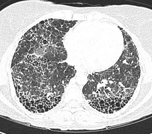 Interstitialis tüdőbetegségek UIP mintázat előfordulásai Asbestosis Idiopathias tüdőfibrosis (IPF) Scleroderma