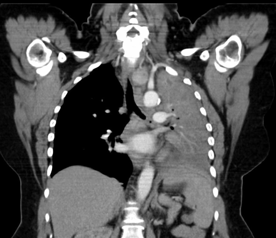 Mediastinum Mediastinum eltolódás - Egyoldali csökkent tüdővolumen (Lobectomia, Atelectasia) - Egyoldali