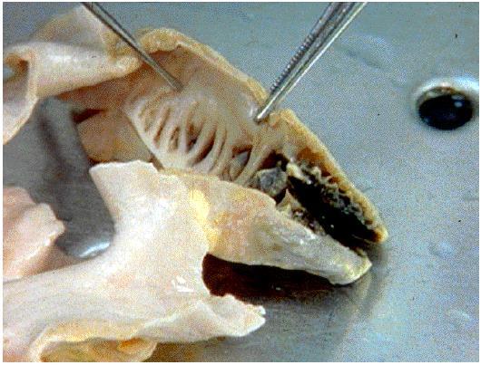 Pitvarfibrillatio (PF) stroke A 80 év feletti stroke-ok 25%-ában oki tényező A stroke éves rizikója a 5-6 x