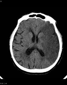 attributable risk of stroke by age Hypertension 53