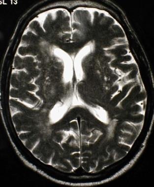 Lacunaris stroke = agyi kisérbetegség Stroke 20-25%-a Penetráló