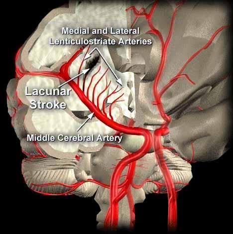 MRI: normal vagy <1,5 cm-es infarctusok Lokalizáció: