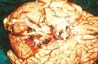 INTRACRANIALIS VÉRZÉSEK Összes stroke: 13-20%