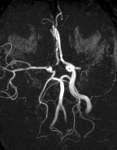 A STROKE TÍPUSAI Ischaemia