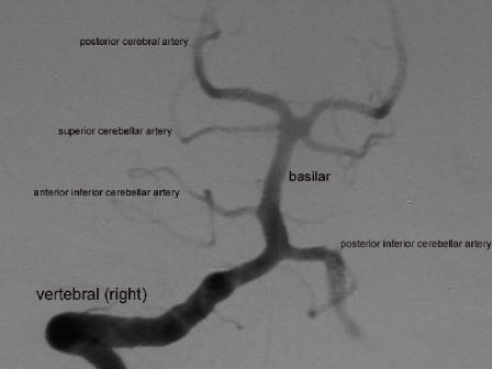 Esetek 85-90%-a 10-15% ANTERIOR TERÜLET A haemispherium többségének vérellátása, kivéve: -occipitalis lebeny - temporalis