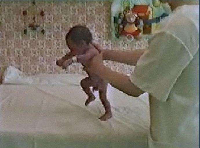 Egy újszülöttet, vagy fiatal csecsemőt asztalra állítva a két alsó végtagja egy idő után kifeszül és a törzs is egyenesedik.