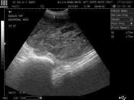 osteomyelitis Sipolyozás után 2 héten belül gyógyul Hosszú immunitás, láz 25% Belső tályogok 8%