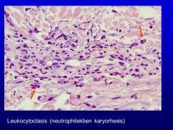 bakteriológai tenyésztés Kórszövettani eredmények Sejtszegény vasculitis 75% Nem