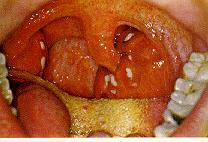 Tonsillitis palatinalis acuta (angina