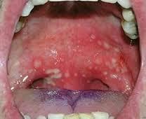 Herpangina (pharyngitis vesicularis) Coxsakie A-vírusfertőzés lencsényi vesiculák a lágyszájpad, garatívek, tonsillák