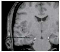 .. Humán egysejt amygdala, entorhinalis kéreg, hippocampus Különböző sejtek szelektívek az identitásra, pózra, emocionális