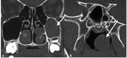 Kifejezett orrlégzési gátoltság (masszív polyposis, lateralis fal medializációja mucoviscidosis) Antrochoanalis polyp Mucocele,