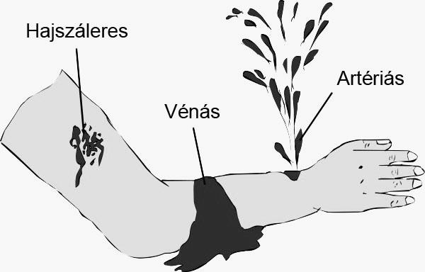 4. Ismertesse a képen látható vérzések jellemzőit, ellátásuk módjait!