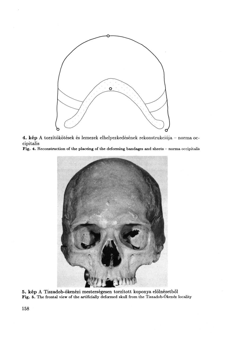 4. kép A torzítókötések és lemezek elhelyezkedésének rekonstrukciója - norma occipitalis Fig. 4.