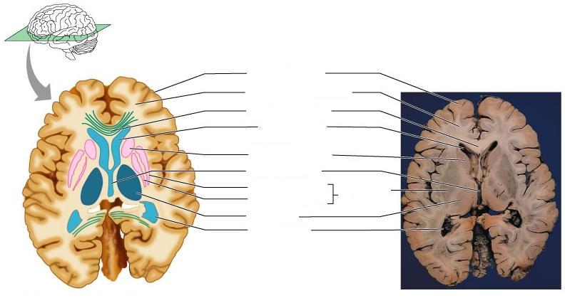 Az emberi agy keresztmetszeti képe elülső régió agykéreg kérgi fehérállomány kérgestest oldalkamra eleje