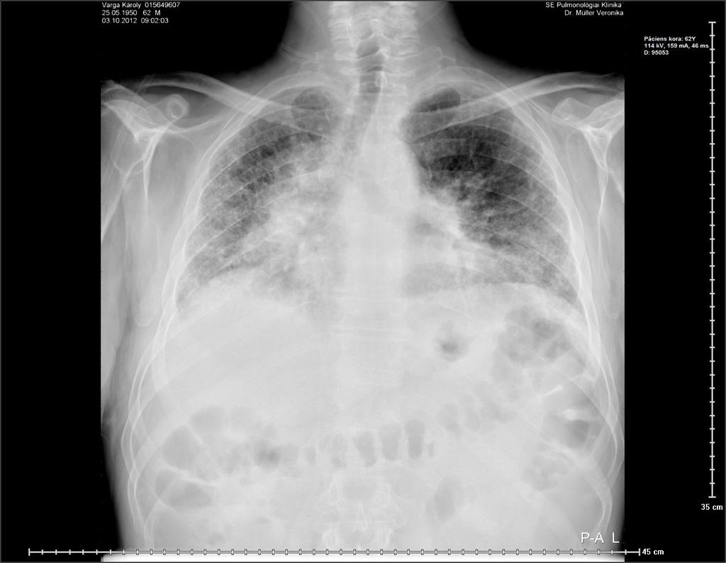 Tüdőfibrosis és tápláltság. Rekeszizom diszfunkció.