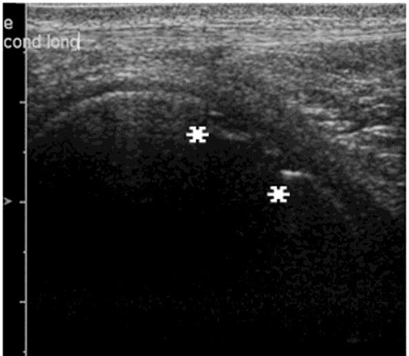 A 8 MHz lineáris fejjel készített felvételnél a transzducer a ló törzsével párhuzamos síkban képezte le a mediális femur condylus felszínét.