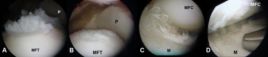 E: az érintett térdízületről készített caudo-cranialis srég röntgenfelévétel, mely a 8 hónap alatt az ízület osteoarthritisenek egyértelmű progrediálását mutatja. 32. ábra. A 10.
