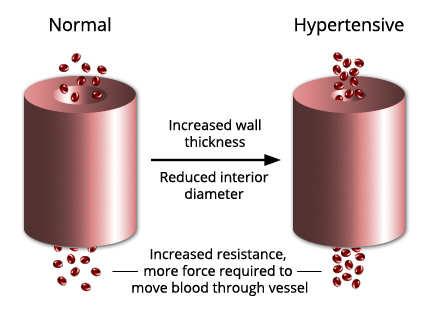 CKD HYPERTONIA