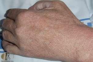 Scleromyxoedema 30-50 éves korban, férfi:nő = 1:1 monoclonalis gammopathia