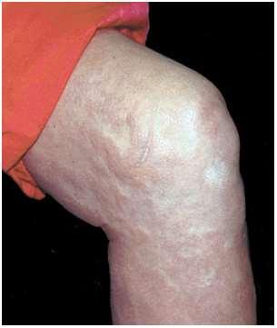 ) narancsbőr jellegű belszervek fibrosisa: izom, myocardium, tüdő trigger: nagy dózisú