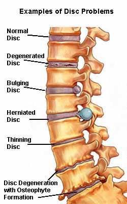 Intervertebralis