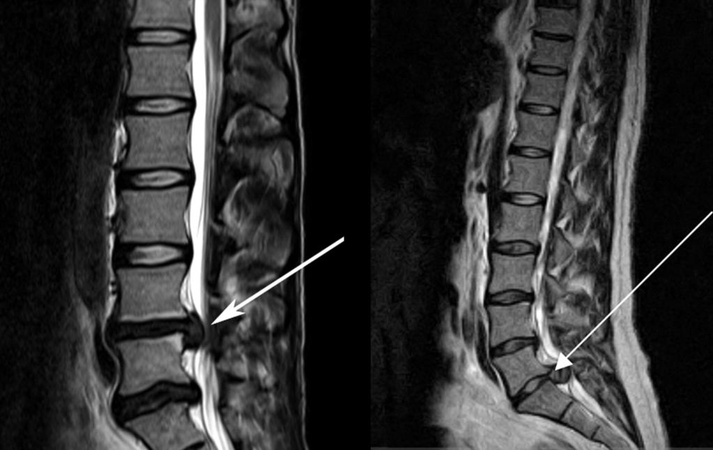 Cauda equina syndromát okozó